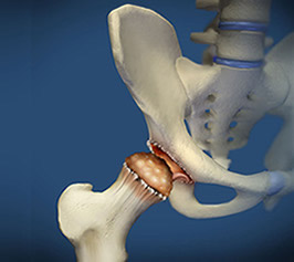 Hip Arthritis